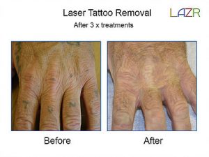 tattoo removal warrington cheshire laser tattoo removal warrington tattoo removal warrington cheshire laser tattoo removal warrington