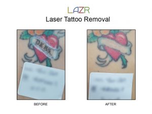 lazrtattooremoval32